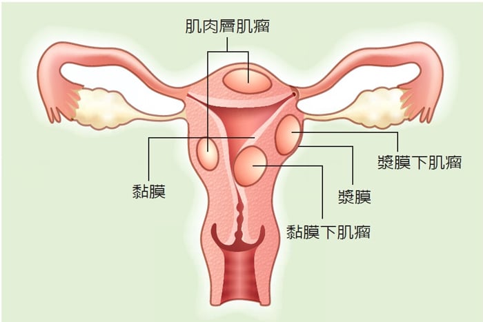 子宮肌瘤