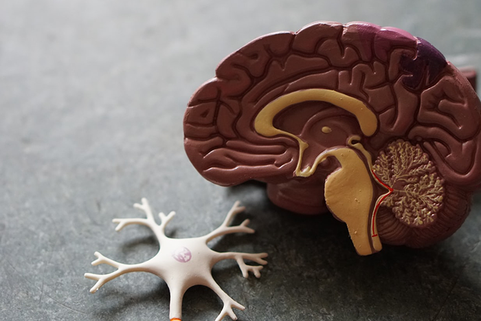 腦部出現不正常斑塊和神經纖維糾結物，是導致阿茲海默症發生的主因之一。