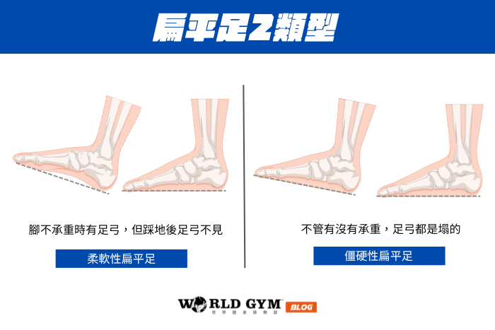 扁平足2類型