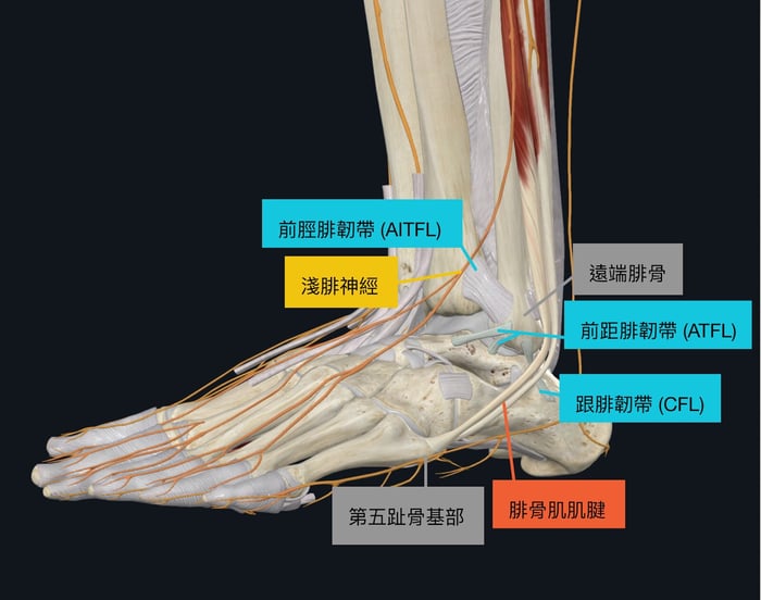 腳踝扭傷 外側