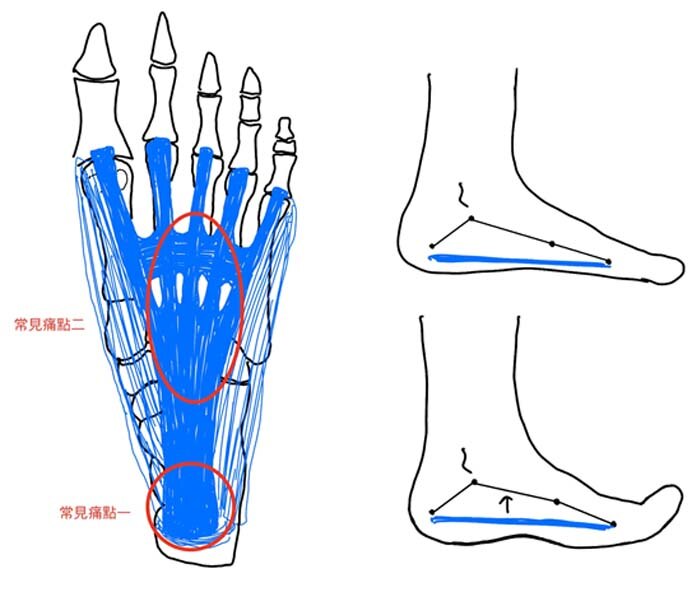 足底筋膜炎是什麼?