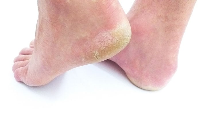 造成腳跟龜裂、粗糙的原因有可能是香港腳
