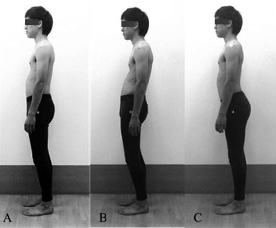 effect-of-standing-postural-deviations-on-trunk-and-hip-muscle-activity