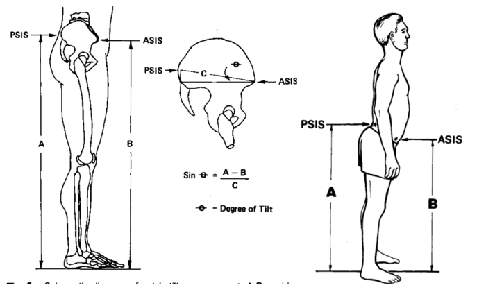 how-to-determine-posterior-pelvic-tilt