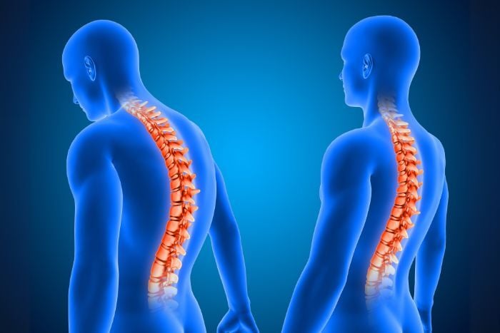 hyperkyphosis