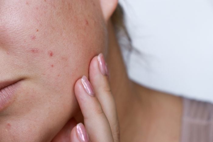 natural-woman-bad-acne-skin-with-scars