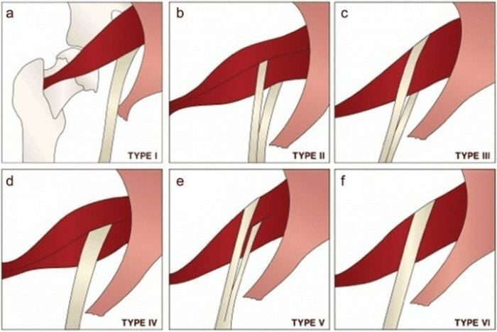 piriformis-syndrome-3