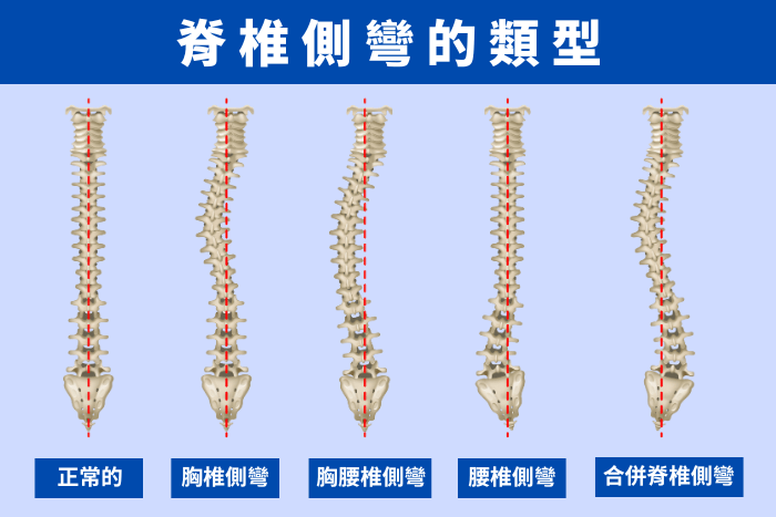 脊椎側彎矯正方法有哪些？從輕度到重度的處理，看物理治療師怎麼說