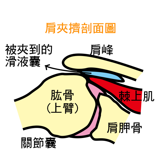 3大肩膀痛症狀 肩夾擠症候群 肩夾擠剖面圖