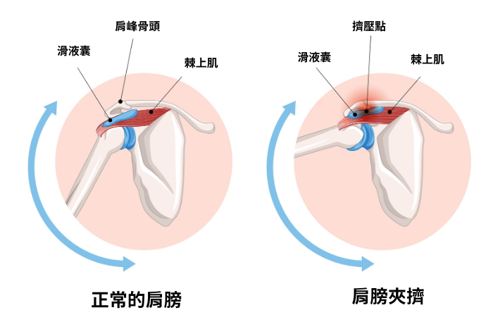 subacromial-pain-syndrome1