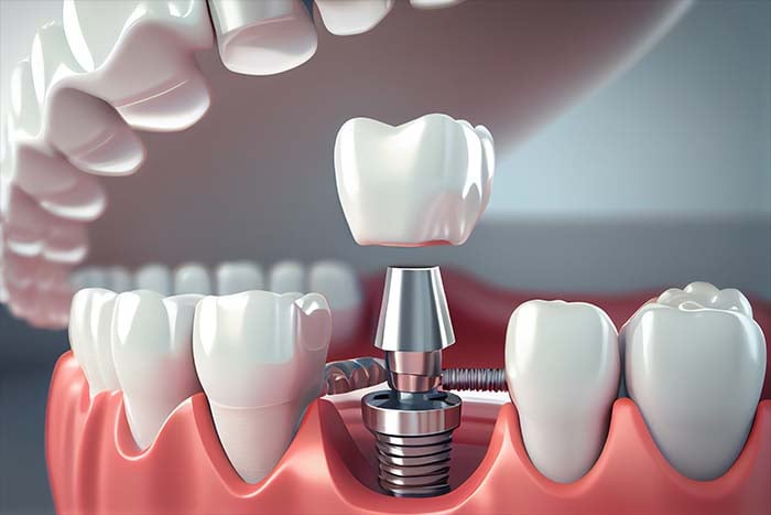 植牙手術是什麼？植牙與牙橋治療的差別是？