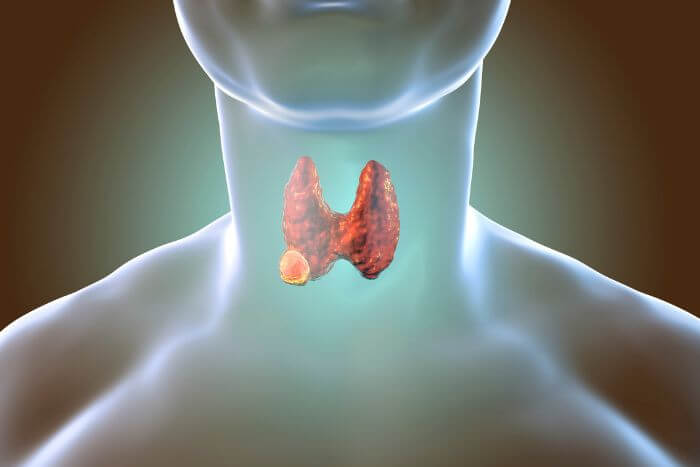甲狀腺機能亢進原因與症狀，患者要避免「含碘」食物