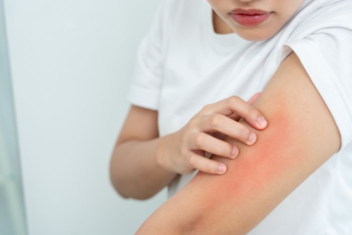 不明原因皮膚癢？中醫師：解析 5 大體質與止癢對策